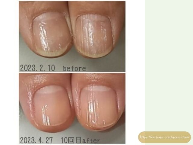 爪 縦筋 原因 対策 保湿