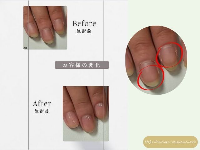 爪の周り 皮膚 硬く 乾燥 小爪 原因 対処法