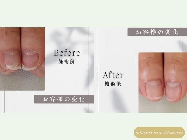 傷んだ爪 アプローチ 健康な指先