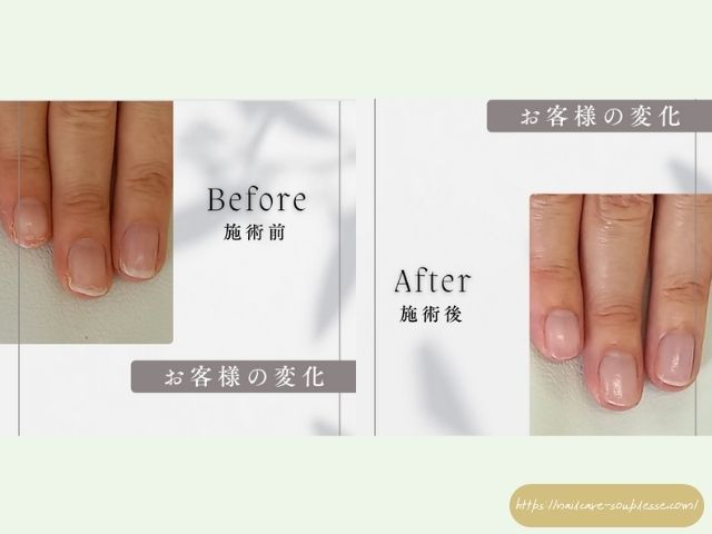 傷んだ爪 アプローチ 健康な指先