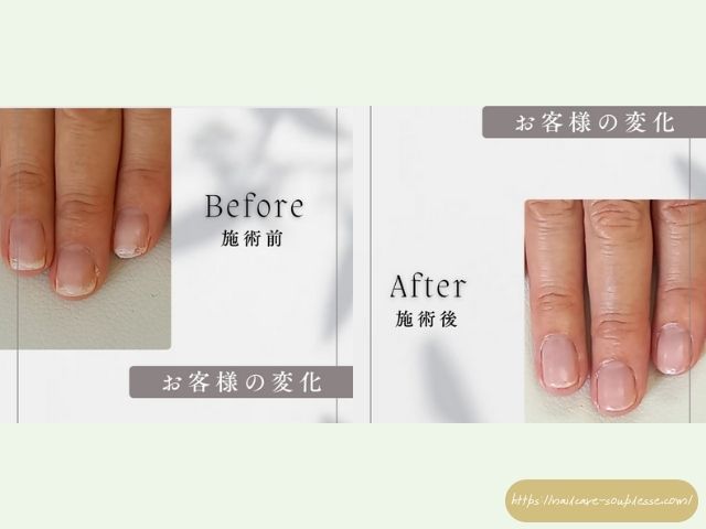 傷んだ爪 アプローチ 健康な指先