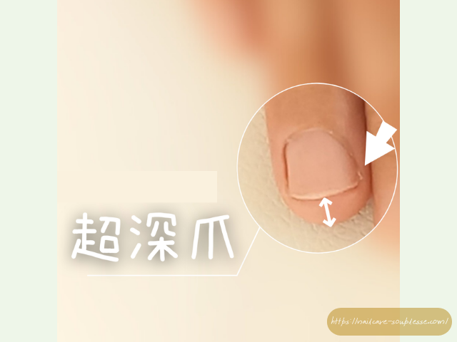 ネイルトラブル 悪化 原因