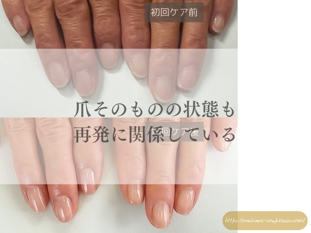 硬く 厚い爪 二枚爪 原因 ホームケア サロンケア 解説